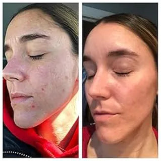 Anti-Aging Light Therapy Mask
